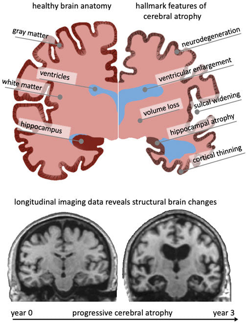 Brain Atrophy in Multiple Sclerosis MS